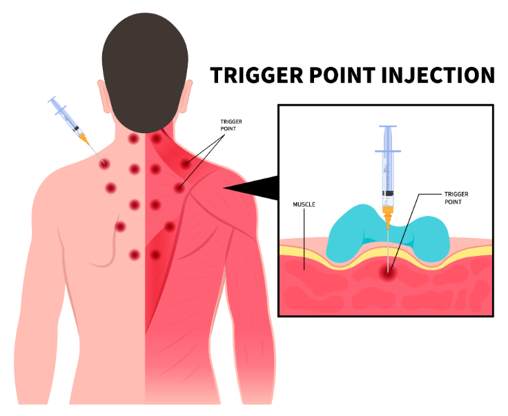 Trigger Point Injection